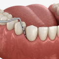 Limpieza dental profunda: qué es, cuándo se necesita y cómo se hace
