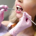 Desgaste dental: Causas, señales de alerta y cómo prevenirlo