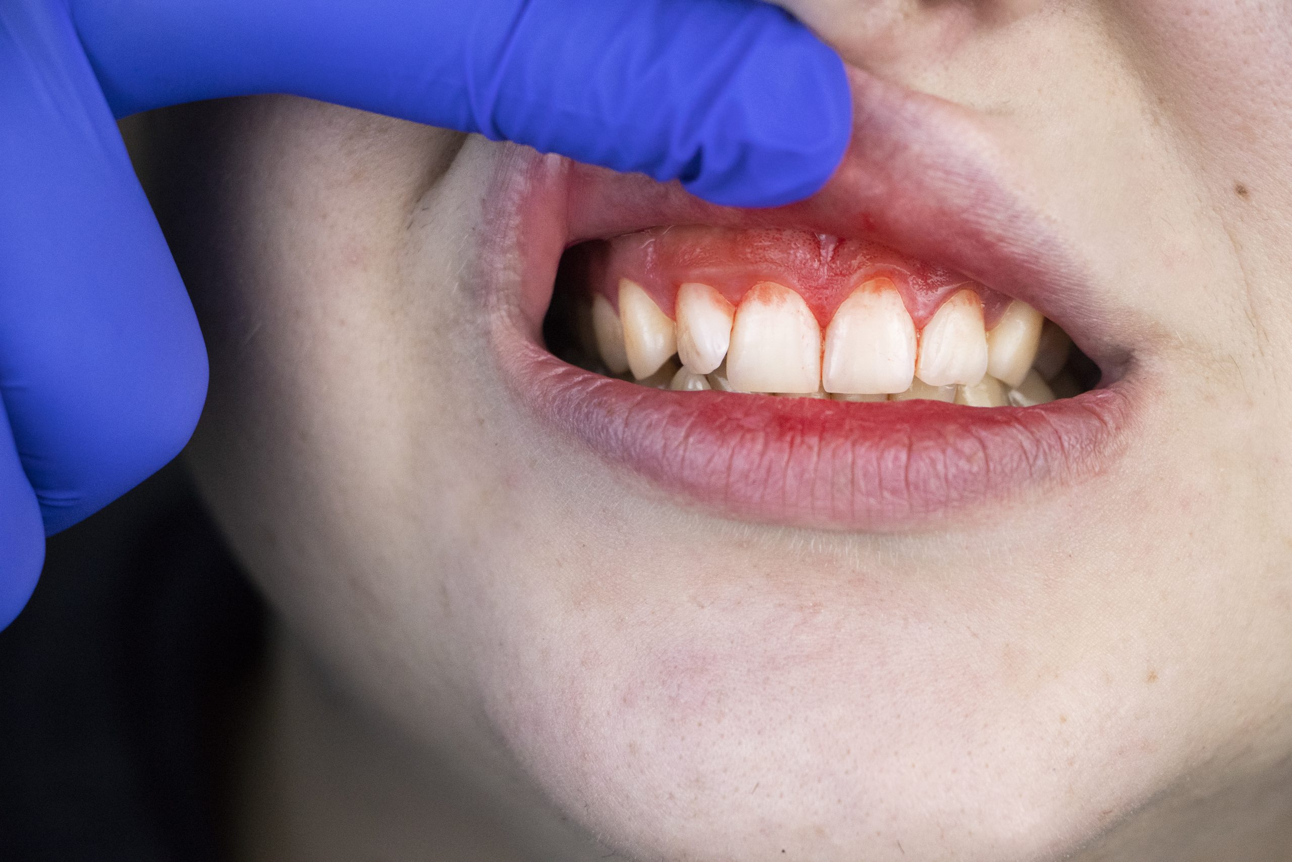 Paciente examinado por dentista para diagnosticar posible gingivitis