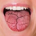 Boca seca o xerostomía: Síntomas, causas, tratamiento y cómo afecta la salud bucal