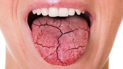 Boca seca o xerostomía: Síntomas, causas, tratamiento y cómo afecta la salud bucal
