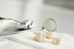 Muelas del juicio extraídas de un paciente en consulta dental