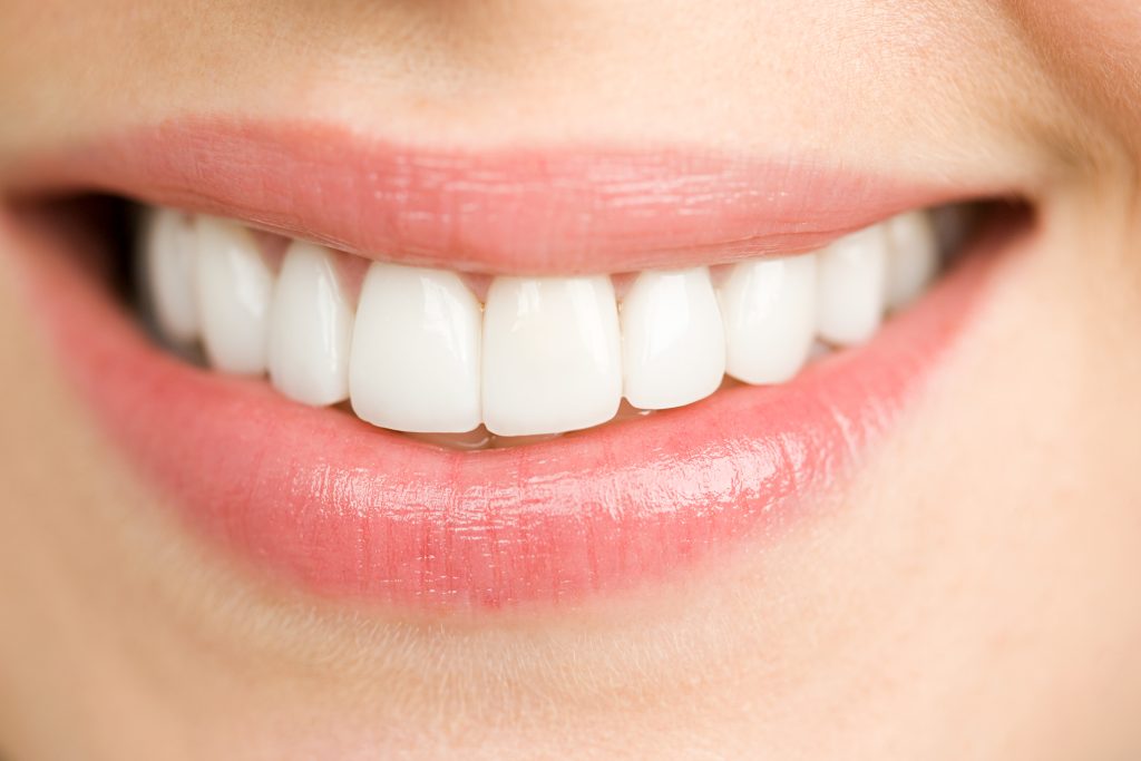 Sonrisa de mujer después de un procedimiento de destartraje dental