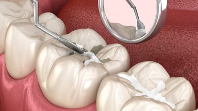 Sellantes dentales: qué son, para qué sirven y cuándo aplicarlos