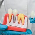 Corona dental: todo lo que necesitas saber sobre esta prótesis