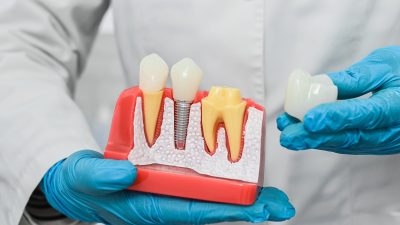 Corona dental: todo lo que necesitas saber sobre esta prótesis