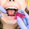 Ortodoncia interceptiva en niños: guía completa para cuidar su desarrollo dental