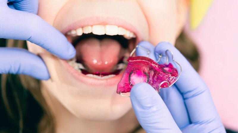 Ortodoncia interceptiva en niños: guía completa para cuidar su desarrollo dental