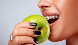 Las almendras no son buena opción: Conoce qué no se puede comer con brackets
