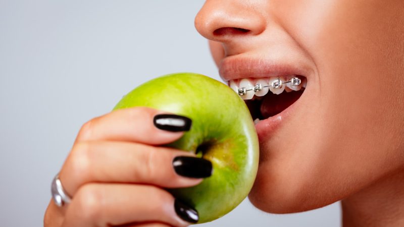 Las almendras no son buena opción: Conoce qué no se puede comer con brackets